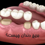 بریج دندان