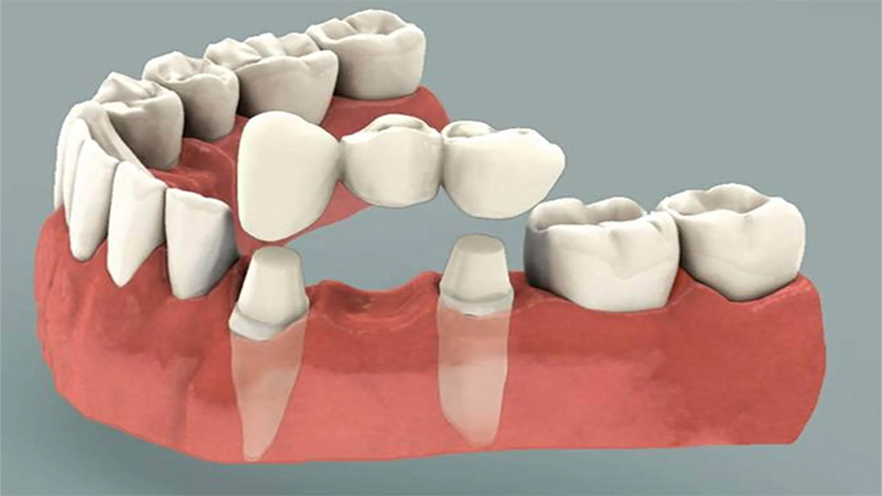 انواع بریج دندان