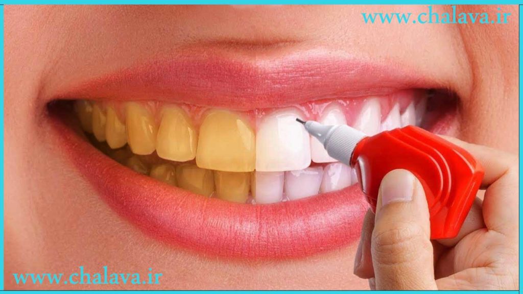 سفید کردن دندان ها برای اصلاح طرح لبخند
