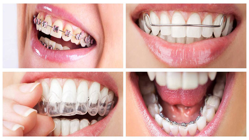 انواع درمان ارتودنسی دندان
