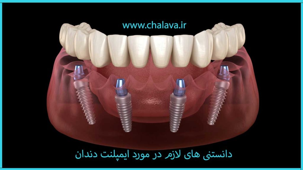 دانستنیهای لازم در مورد ایمپلنت دندان