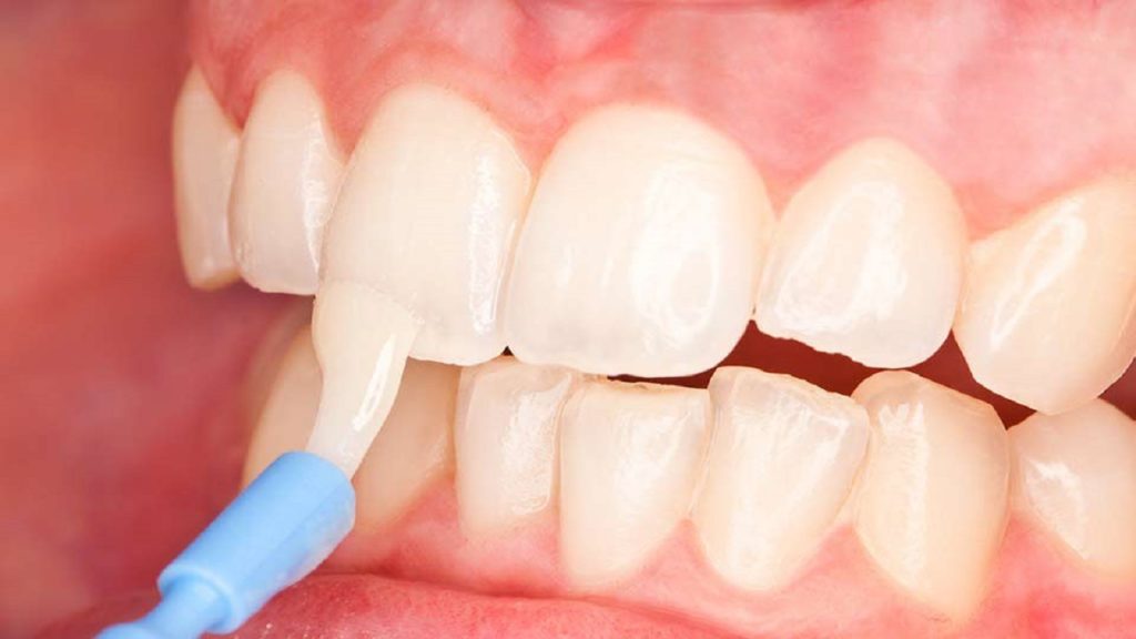 فلوراید در دندانپزشکی کودکان