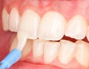 فلوراید در دندانپزشکی کودکان