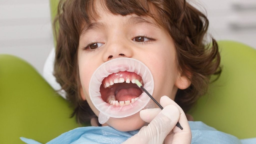 وارنیش-فلوراید-دندان-کودکان-و-بزرگسالان