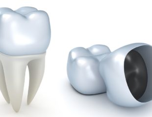 بیلداپ یا ترمیم دندان