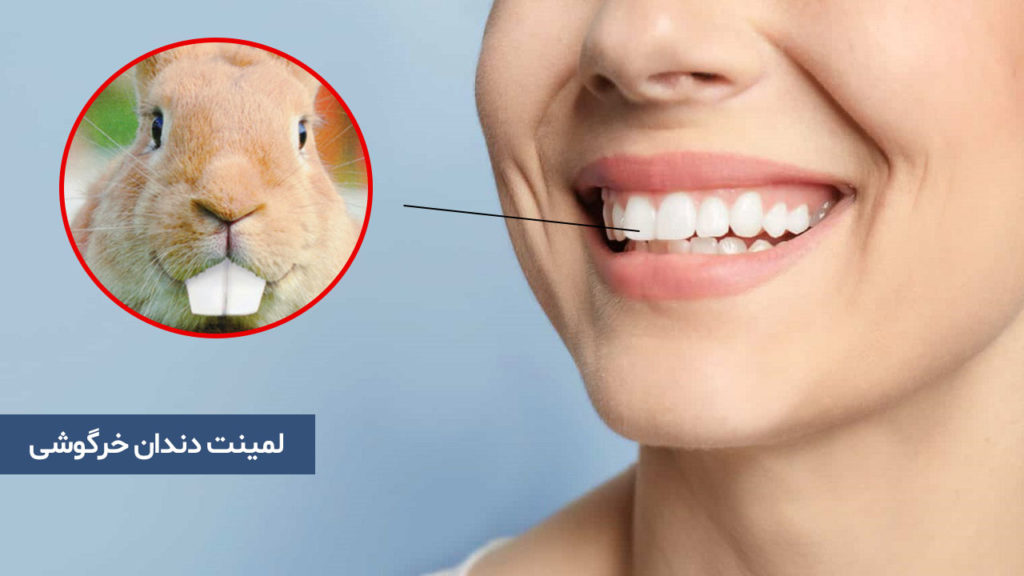 لمینت دندان خرگوشی
