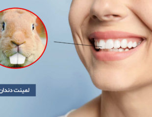 لمینت دندان خرگوشی