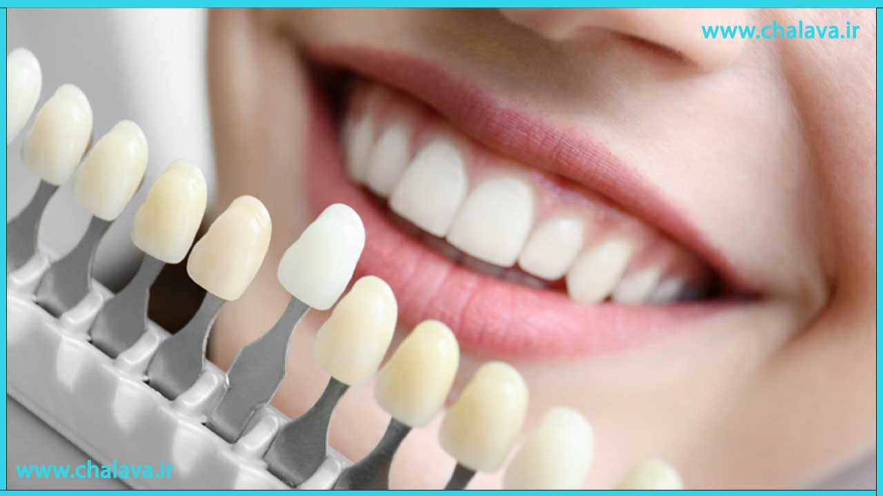 روکش دندان لمینت