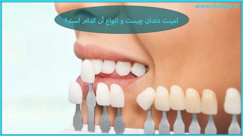 لمینت دندان چیست؟