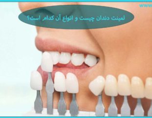 لمینت دندان چیست؟