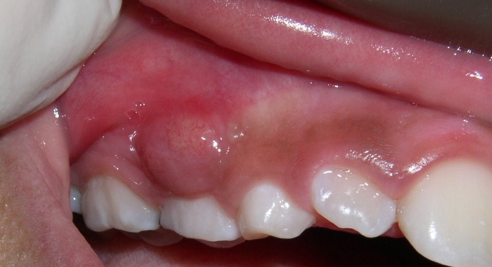  آبسه دندان 