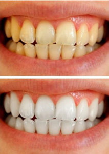 متخصص‌ترمیم و زیبایی دندان، سفید کردن دندان