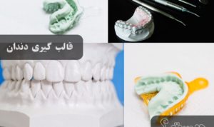 لمینت دندان اقساطی، قالب‌گیری دندان‌ها