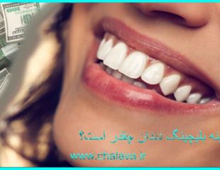هزینه بلیچینگ دندان