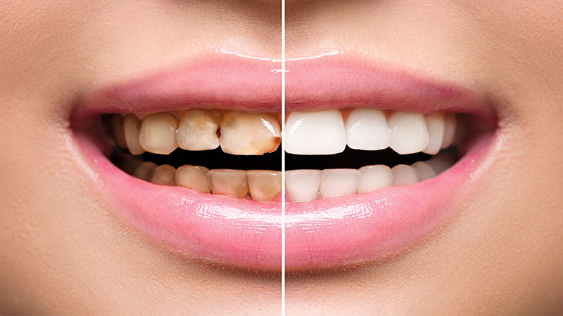 عوامل ایجاد جرم بر روی دندان
