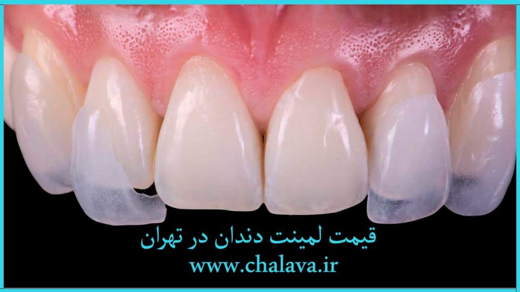 هزینه لمینت دندان در تهران