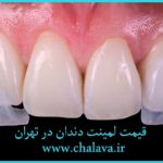 هزینه لمینت دندان در تهران