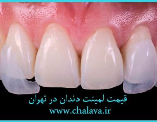 هزینه لمینت دندان در تهران