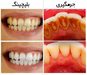 جرم گیری دندان‌ها-2