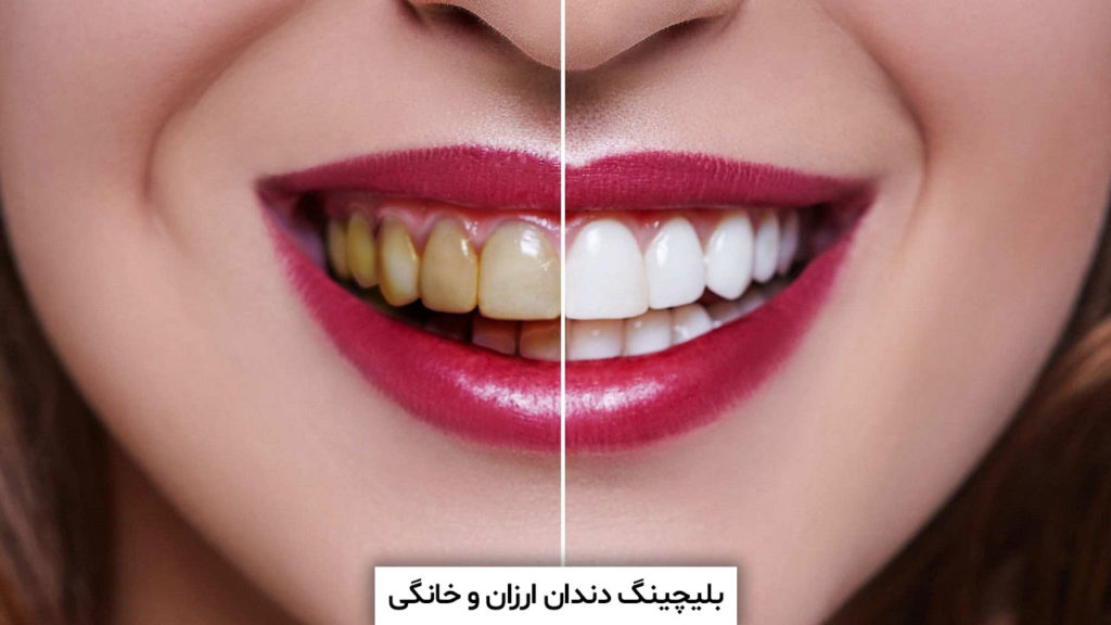 بلیچینگ دندان ارزان