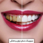بلیچینگ دندان ارزان