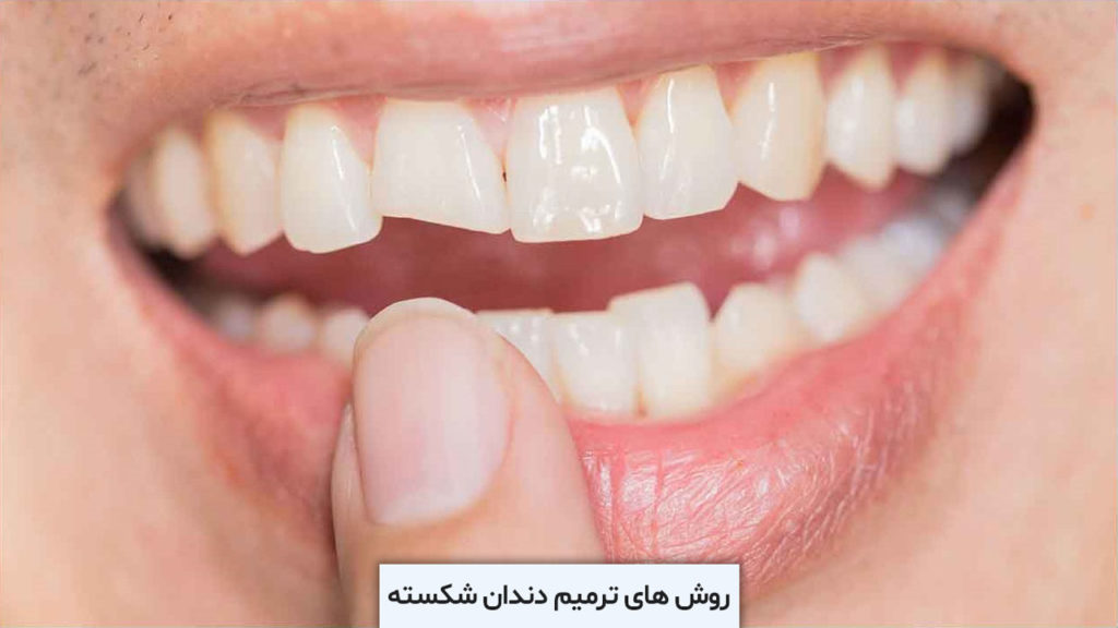 ترمیم دندان شکسته