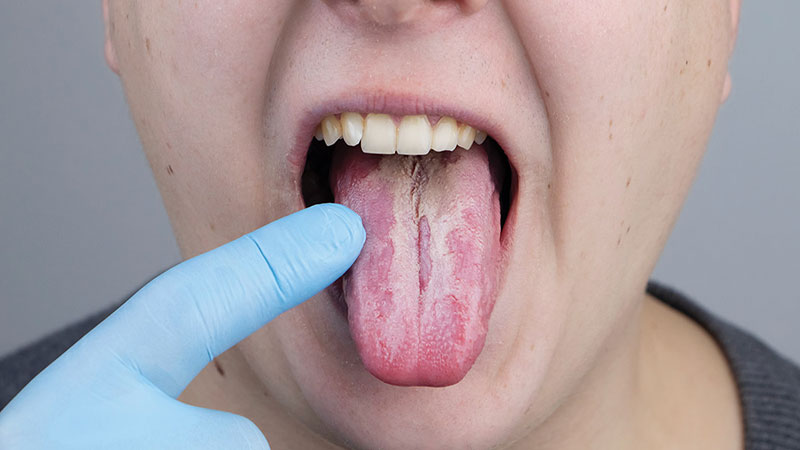 عفونت دهان لکوپلاکیا