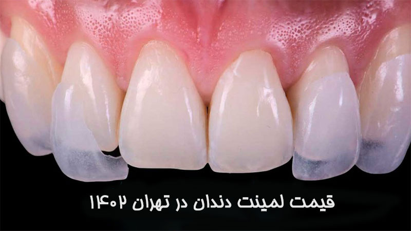 قیمت لمینت دندان در تهران 1402