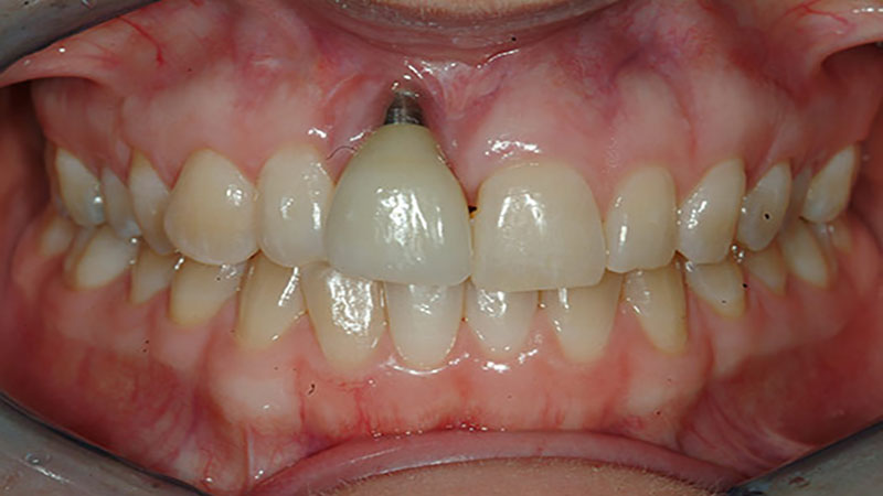 علائم شکست ایمپلنت دندان