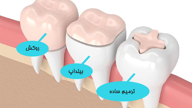 بیلداپ بهتر است یا روکش