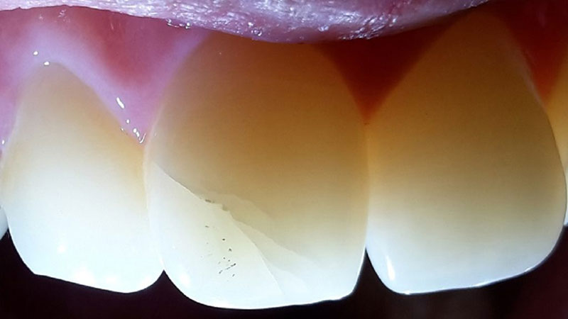 ترک خوردگی علت درد دندان