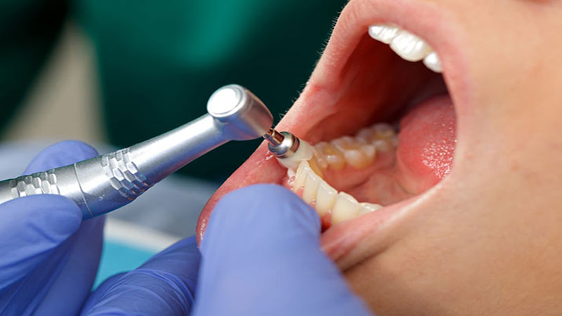 تمیز کاری‌ های منظم در مطب دندان‌ پزشک