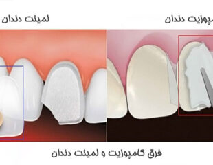 فرق کامپوزیت و لمینت دندان