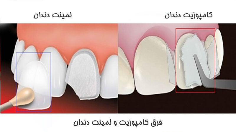 فرق کامپوزیت و لمینت دندان