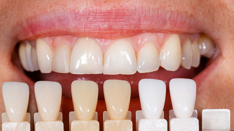 فرق کامپوزیت و لمینت دندان در چیست؟