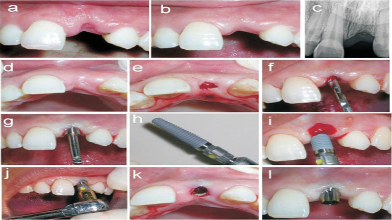 روند فرآیند ایمپلنت دندان