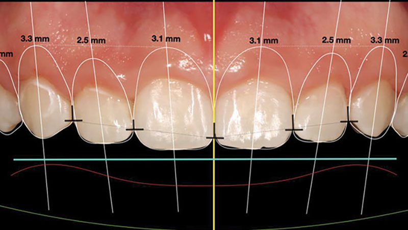 مراحل افزایش طول تاج دندان