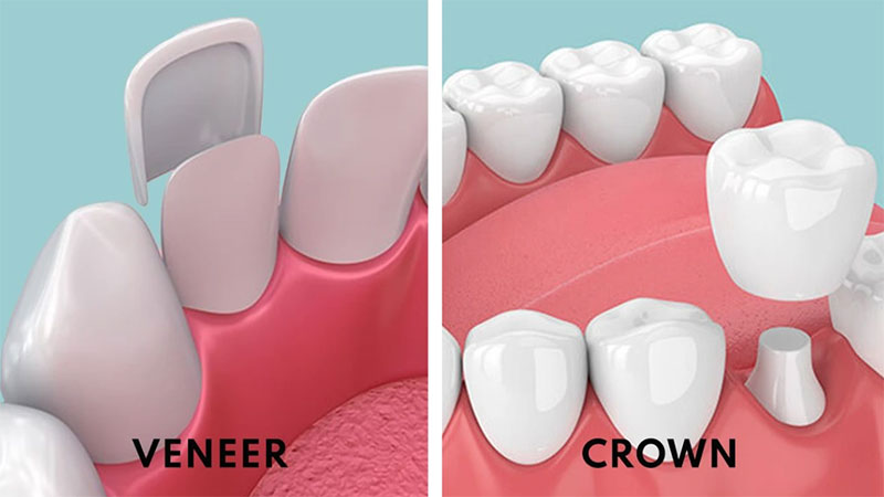 روکش یا تاج دندان