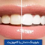 بلیچینگ دندان یا کامپوزیت