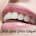لمینت دندان بدون تراش