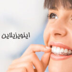 اینویزیلاین چیست
