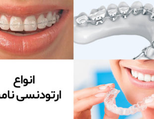 انواع ارتودنسی نامرئی دندان