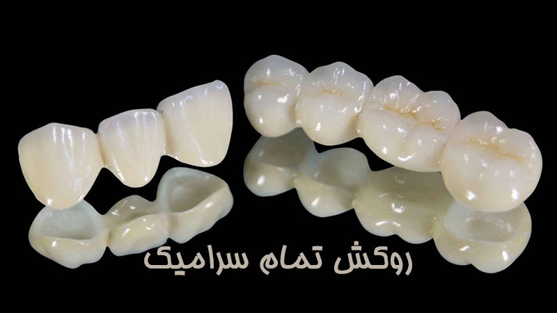 روکش تمام سرامیک