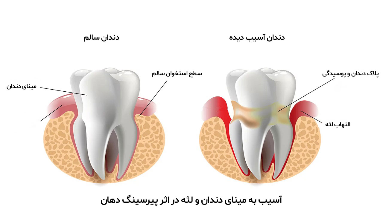 آسیب به مینای دندان و لثه با پیرسینگ دهان