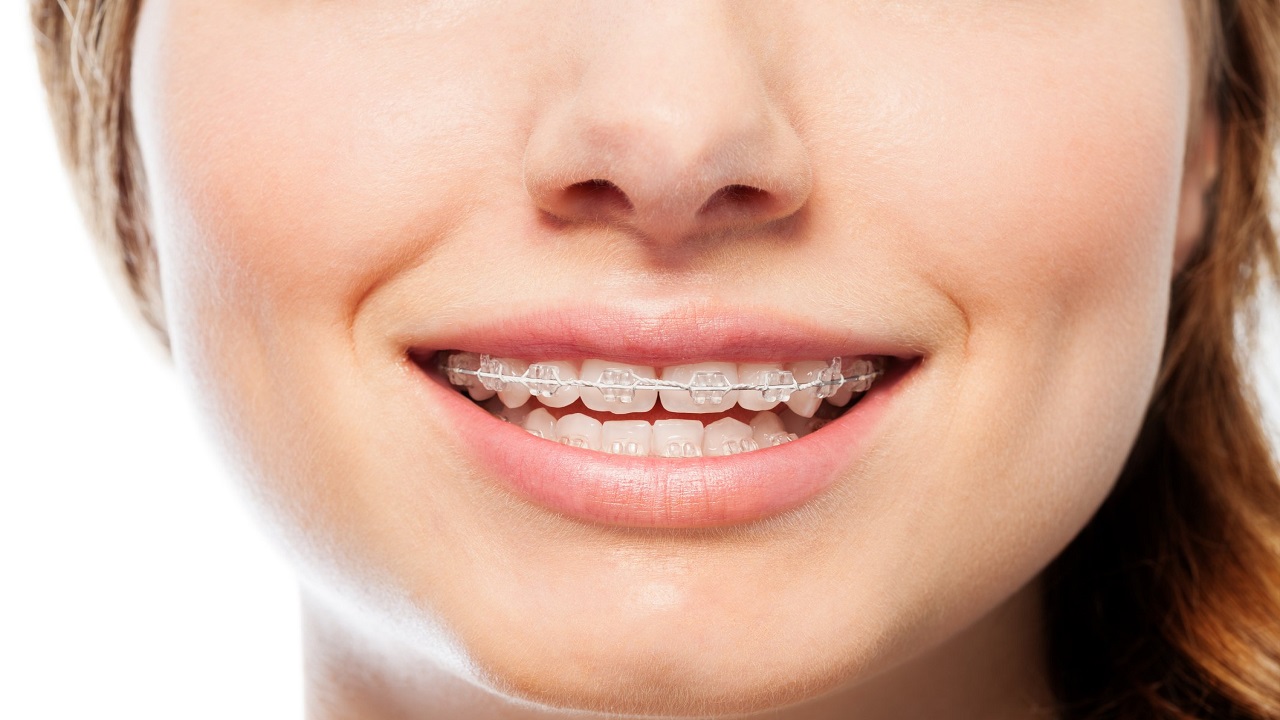 ارتودنسی ثابت سرامیکی