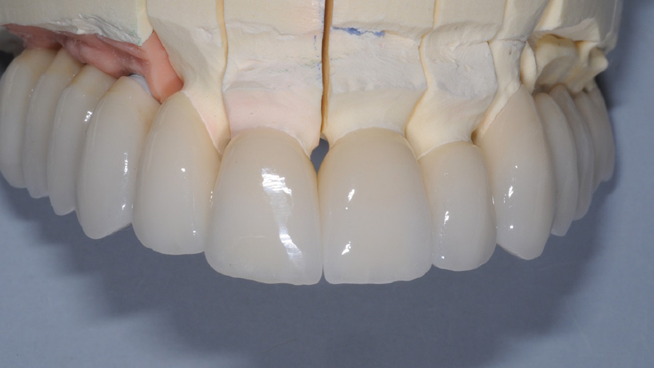 کدام نوع از روکش های سرامیکی انتخاب بهتری برای دندان های شماست؟