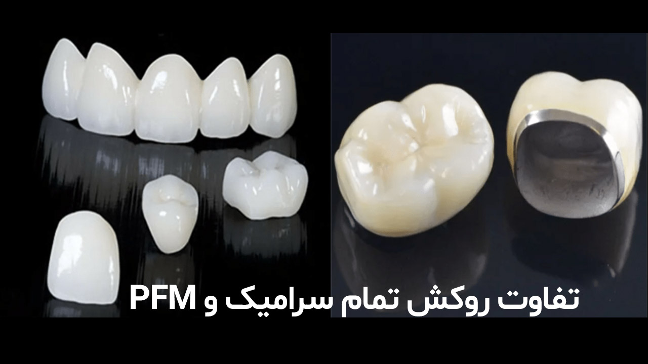  تفاوت روکش تمام سرامیک و PFM