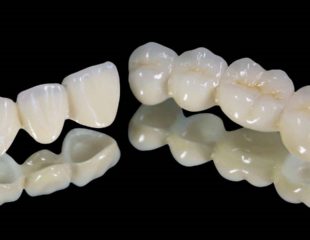 روکش تمام سرامیکی