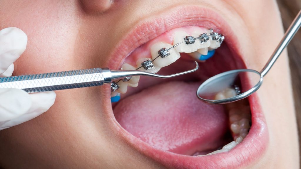 مراحل ارتودنسی دندان