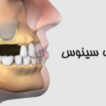 لیفت سینوس